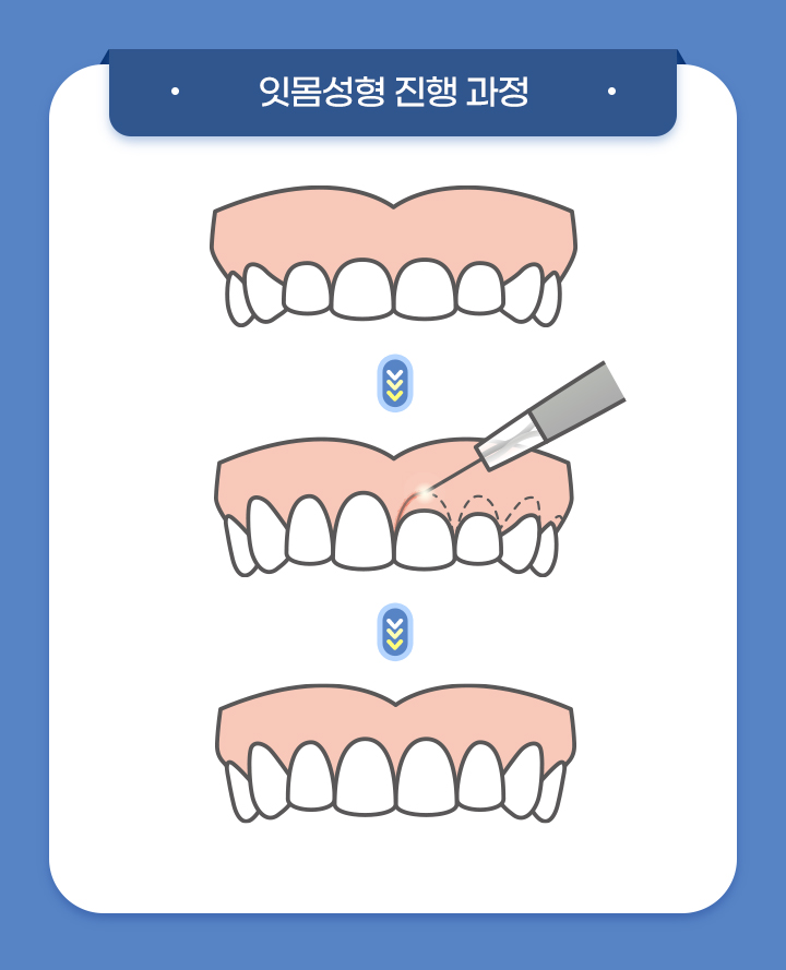 사상맥치과 잇몸성형